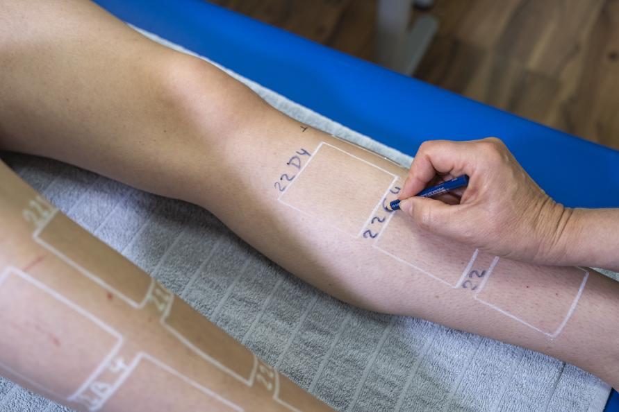 Laboratoriet markerar de sex behandlingsytorna på varje ben. Foto: Tobias Meyer